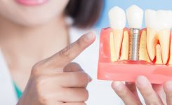 Implantes dentales: todo lo que necesitas saber