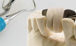Todo lo que necesitas saber sobre los puentes dentales