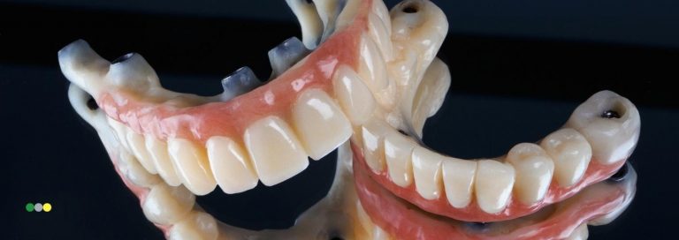 Principales diferencias entre prótesis dental y puente dental