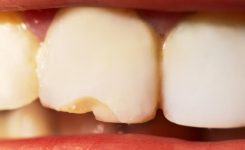 Tipos de fractura dental y tratamientos