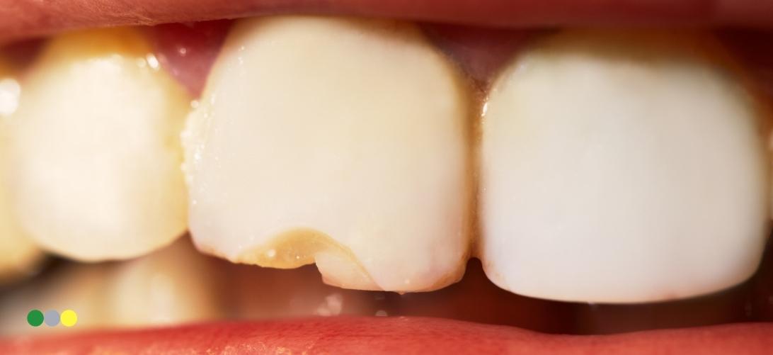 Tipos y soluciones para la fractura dental
