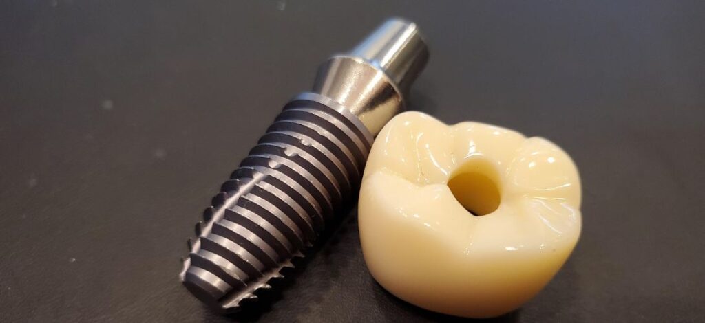 Implantes dentales de carga inmediata